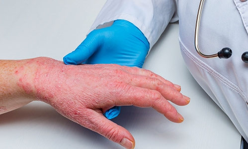 Người bị bệnh lý về da sử dụng diệt khuẩn chứa cồn khiến bệnh nặng hơn, khó lành da